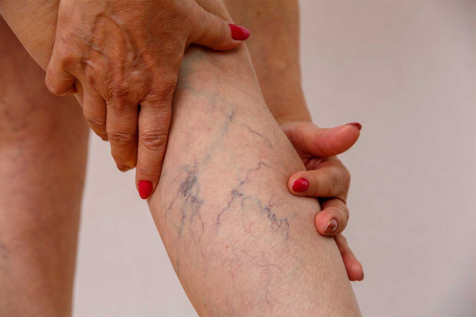 Minimal-invasive-laser-and-glue-therapy-for-varicose-veins